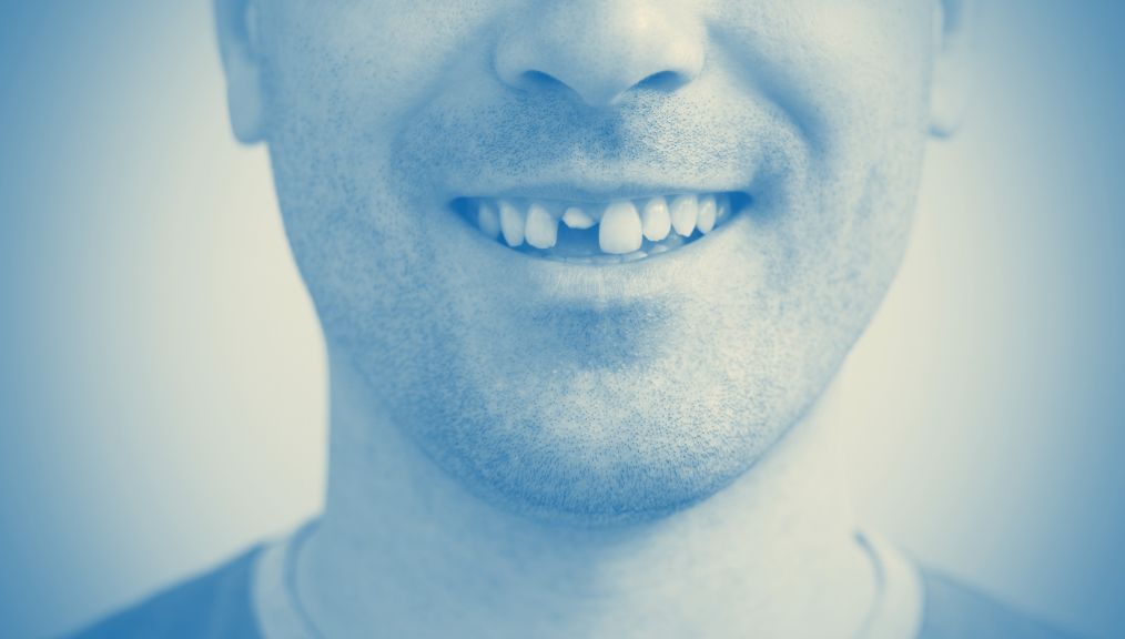 broken-tooth-dentist-central-alberta