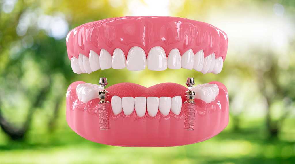 implant-supported-dentures-bentley-dentistry-alberta